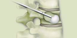 11 Kyphoplasty and Vertebroplasty