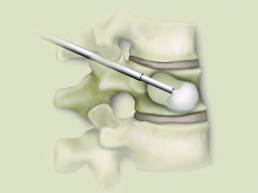 11 Kyphoplasty and Vertebroplasty