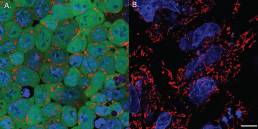 4-Stem-Cell-Assisted-Spinal-Fusion