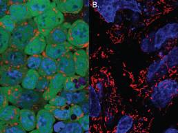 4-Stem-Cell-Assisted-Spinal-Fusion