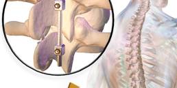 6 Minimally Invasive Spine Surgery (MISS)