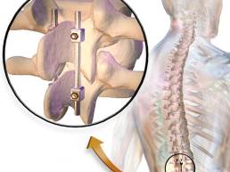 6 Minimally Invasive Spine Surgery (MISS)