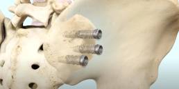 7 Oblique Lumbar Interbody Fusion (OLIF)