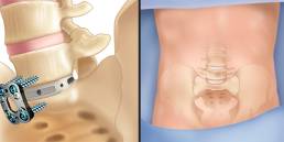 Anterior Lumbar Interbody Fusion