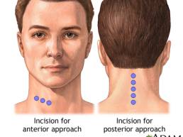 Cervical Anterior and Posterior Fusion