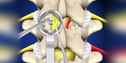 Cervical & Lumbar Laminectomy and Foraminotomy