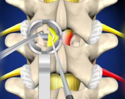 Cervical & Lumbar Laminectomy and Foraminotomy