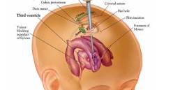 Endoscopic Brain Surgery