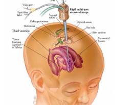Endoscopic Brain Surgery