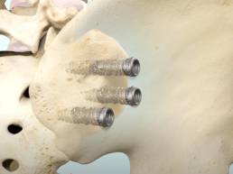 Sacroiliac (SI) Joint Fusion