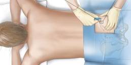 Stem Cell Injections